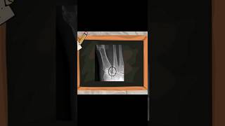 Radiological Signs of Lisfranc Injury lisfranc ortholectures orthopaedics orthodoc ortho [upl. by Nawtna]