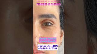 Qovoq olish  қовоқ олиш  blefaroplastika Doctor ODILJON 998974347791 TOSHKENT VA JIZZAXDA rek [upl. by Ettenrahc591]