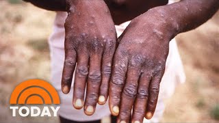 How To Identify A Monkeypox Rash Symptoms To Look Out For [upl. by Aileen]