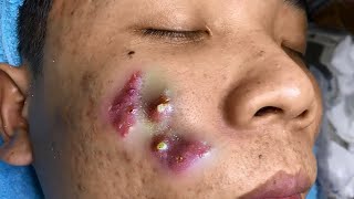 Big Cystic Acne Blackheads Extraction Blackheads amp Milia Whiteheads Removal Pimple Popping [upl. by Toogood284]