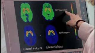 Brain imaging gives new insight into underlying cause of ADHD [upl. by Gillead633]