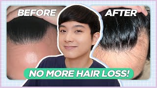 How I STOPPED My RECEDING HAIRLINE My Hair Loss Treatment Journey Filipino  Jan Angelo [upl. by Holms123]