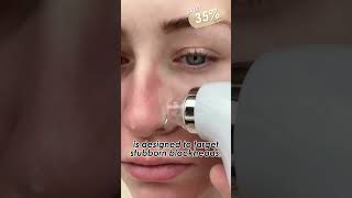 electric blackhead remover [upl. by Thrift257]