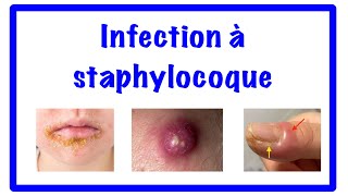 🔵les infections a staphylocoque [upl. by Nnahtebazile538]