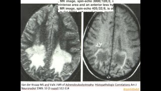 48 Xlinked Adrenoleukodystrophy XALD metabolic peroxisomal very long chain fatty acids VLCFA [upl. by Fanchie31]