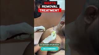 Warts Removal Treatment  Ayurawa Ayurveda DrGayathri Kooragoda treatment ayurveda [upl. by Brie]