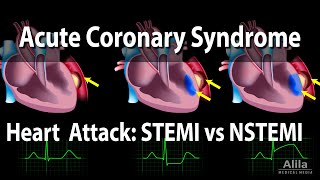 Acute Coronary Syndrome Unstable Angina NSTEMI and STEMI Heart Attack Animation [upl. by Tod]