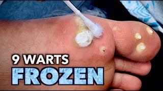 9 WARTS FROZEN on 1 FOOT with liquid nitrogen  Dr Paul [upl. by Suu538]