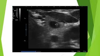 Colloïde versus calcification en échographie thyroïdienne [upl. by Amabelle]