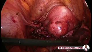 Laparoscopic Surgery For Severe Endometriosis by Dr Abayomi Agbetoba [upl. by Hayouqes423]