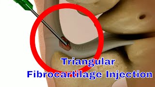 Triangular Fibrocartilage Complex TFCC Injection Technique A StepbyStep Guide [upl. by Eitsyrc]