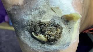 Pedicure video15，largeblack plantar wart [upl. by Finstad]