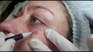 451 Seborrheic Keratosis Removal under the eye  skin type III [upl. by Yerkovich557]