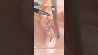 Laparoscopic Suturing Techniques [upl. by Lehplar563]