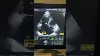 Cor Pulmonale on 2D echo cardio echo heart [upl. by Eledoya]