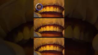 Metal Ceramic PFM vs All Ceramic Zirconia Crowns  Which is Better for Front Teeth  dentalcrowns [upl. by Gorrian]