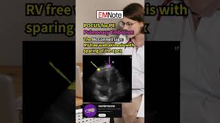 Pulmonary Embolism Ultrasound doctor medical [upl. by Gnouh]