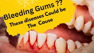 Why Your Gums Are Bleeding Causes of Bleeding Gums [upl. by Nimocks]