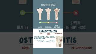 Bone Health Common Diseases You Should Know🦴 youtubeshorts information factshealth disease [upl. by Lletnom]