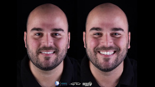 Lentes de contato dentais com o Dentista dos dentistas  Dental Esthetic Center [upl. by Huskey]