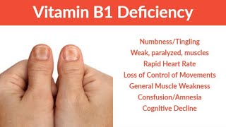 Thiamine Vit B1 Thiamine Vit B1Deficiency  Signs  Symptoms amp Treatment [upl. by Eeryt]