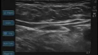 Femoral Nerve Ultrasound [upl. by Icat]