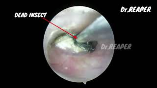 CASE NO06  INSECT TRAPPED INTO EAR FROM LAST 2 DAYS  DEAD INSECT REMOVED FROM EAR  F B REMOVAL [upl. by Esilahc328]