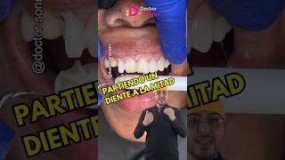 Así se retira una carillasdentales protesisdental Carillas dentista shorts dientesblancos [upl. by Ahsinna580]