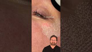 Fractional CO2 Laser Treatment Surgeon Reacts [upl. by Adamina]