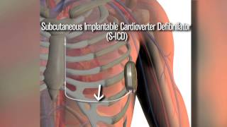 New SICD defibrillator a safety net for cardiac patients [upl. by Ecertak]