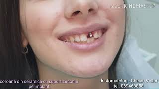 Stomatologie Chisinau BotanicaTerraDent Moldova Coroana din Ceramica cu ZIRCONIU  PE IMPLANT [upl. by Peednama]