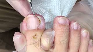 503 Toenail ASMR and Pedicure DIY Toenail ASMR and Pedicure DIY [upl. by Nedrah]