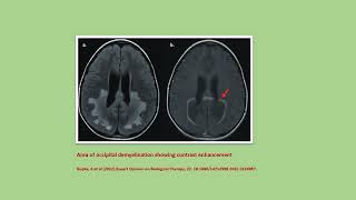 Neurology Quiz 91 Adrenoleukodystrophy [upl. by Coke559]