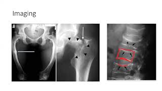 Osteomalacia and Rickets [upl. by Ace975]