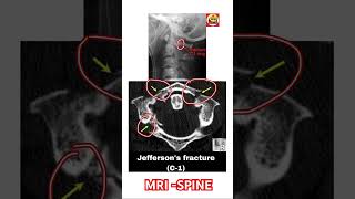 Jaffersons fracture C1 spinal MRI like share subscribe the channel for more details [upl. by Tessy]