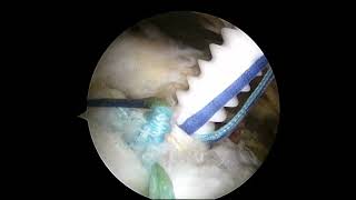 biceps rerouting 6  supraspinatus tendon repair [upl. by Nosreffej]