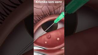 ASMR eye stone removal animation  Eyelid Sebum Extrusion Animation  Meibomian Gland Cleaning [upl. by Derk]