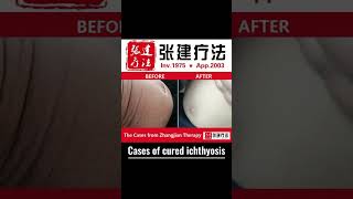 Real recovery case of ichthyosis of belly parts ichthyosis skincare dermatologistdryskinremedy [upl. by Arsuy]