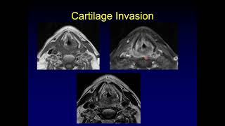 Larynx Anatomy for Staging Squamous Cell Carcinoma Part 2 [upl. by Eceerahs]