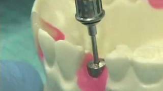 Placing Implant Abutments [upl. by Hannover803]