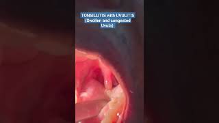 The ULTIMATE VIEW of TONSILLITIS with UVULITIS Watch Now shorts short viral trending [upl. by Tterb989]