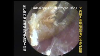 Appearance and treatment methods of fungal otitis externa 20231207 [upl. by Maag770]