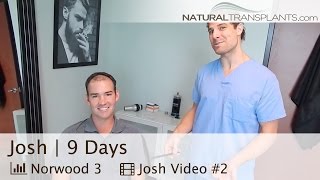 Hair Transplant Suture Removal  FUT vs FUE Scar Truth  West Palm Beach FL Josh [upl. by Short]