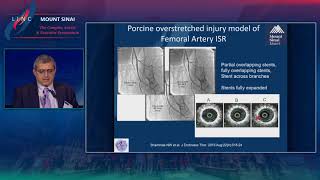 Atherectomy for Restenosis Future of Combination Therapy [upl. by Anyak]