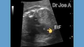 EIF  Echogenic Intracardiac Focus in Left Ventricle  How I Got Stress Free  Scientific Evidence [upl. by Schultz260]