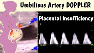 Ultrasound Umbilical Artery Doppler  Placental Insufficiency [upl. by Hgielah]