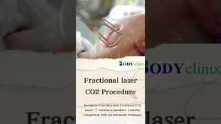 Fractional Laser CO2 Treatment Achieve Smooth amp Youthful Skin at BodyClinix [upl. by Manthei]