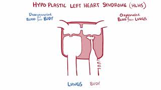 What is the Norwood Procedure for Hypoplastic Left Heart Syndrome [upl. by Thorma513]