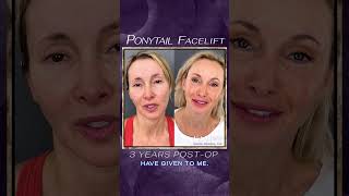 Ponytail Facelift Plastic Surgery Results Part 6 At Kao Plastic Surgery facelift beforeandafter [upl. by Suzzy213]