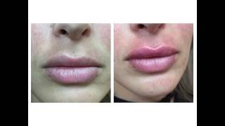 Juvederm Lips by Anusha in West LA [upl. by Aciretahs]